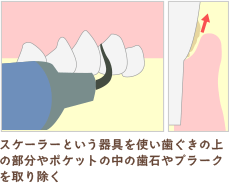 歯周病治療